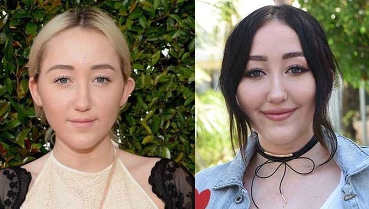 Noah Cyrus And Plastic Surgery What S The Real Story Plastic