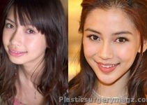 Angelababy Plastic Surgery