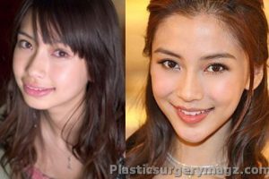 Angelababy Plastic Surgery