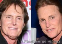 Bruce Jenner Before & After Plastic Surgery