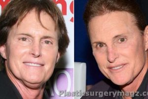 Bruce Jenner Before & After Plastic Surgery