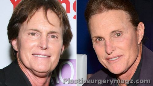 Bruce Jenner Before And After Plastic Surgery Pictures Plastic Surgery Diary