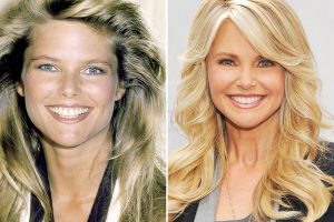 Christie Brinkley Plastic Surgery Before & After