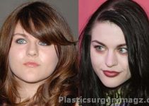 Frances Bean Cobain Plastic Surgery