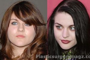 Frances Bean Cobain Plastic Surgery