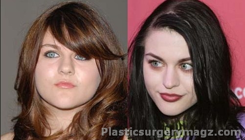 Frances Bean Cobain Plastic Surgery Pictures - Plastic Surgery Diary