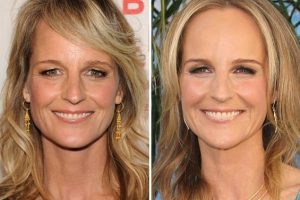 Helen Hunt Plastic Surgery