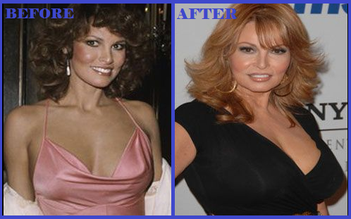 Raquel Welch plastic surgery before and after