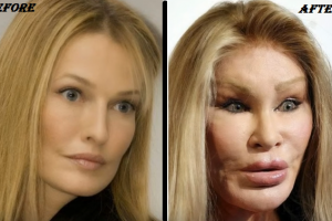 jocelyn wildenstein Before & After plastic surgery