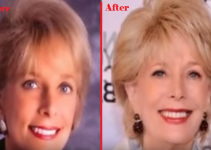 leslie stahl plastic surgery Before & After
