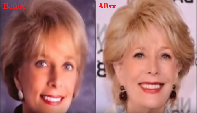 Leslie Stahl Plastic Surgery - Before and After - Plastic Surgery Diary