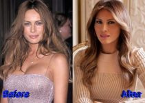 Malania Trump Botox
