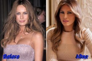 Malania Trump Botox