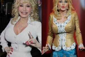 Dolly Parton Liposuction