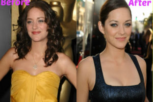 Did Marion Cotillard Have Breast Implants?
