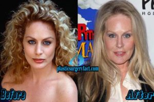 Beverly D’Angelo Plastic Surgery Before And After Photos