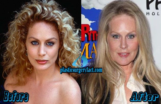 Beverly D’angelo Plastic Surgery Before And After Photos Plastic Surgery Diary