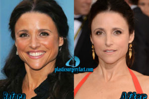 Julia Louis-Dreyfus Plastic Surgery Before And After Photos