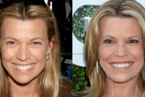 Vanna White Seems Has Done Plastic Surgery