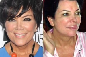 Kriss Jenner Before Plastic Surgery
