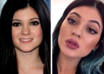 Better Lips than Kylie Jenner Before Plastics Surgery