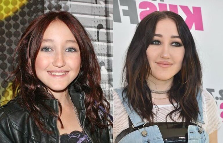 noah cyrus plastic surgery Image 5