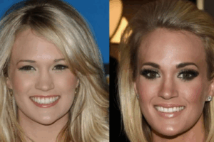 Carrie Underwood Plastic Surgery: What Fans Are Saying