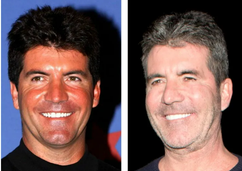 simon cowell plastic surgery