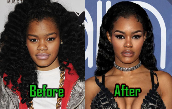 Exploring Teyana Taylor's Most Notable Plastic Surgery Changes