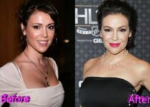 Alyssa Milano Plastic Surgery Before And After