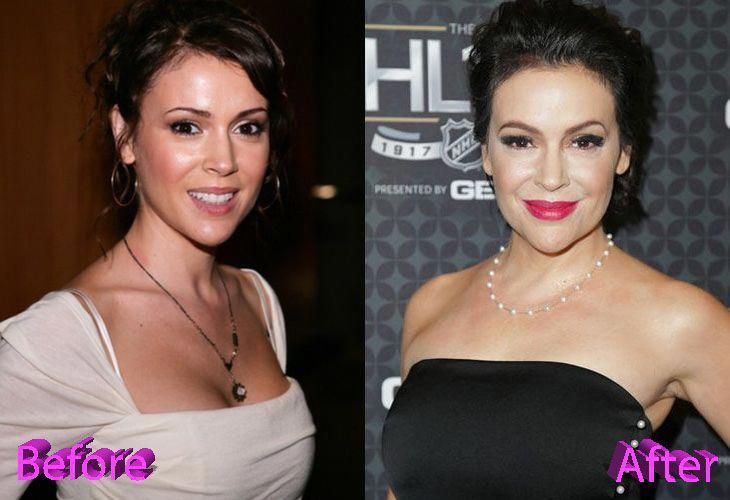 The Impact of Alyssa Milano's Cosmetic Enhancements on Her Career